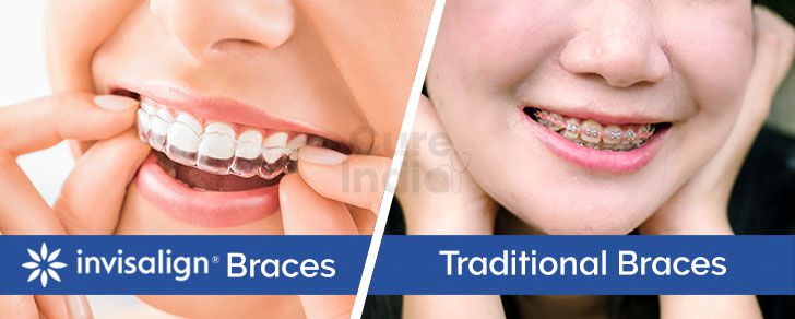 Braces vs Aligners: Which treatment is best for you? - Indiadens